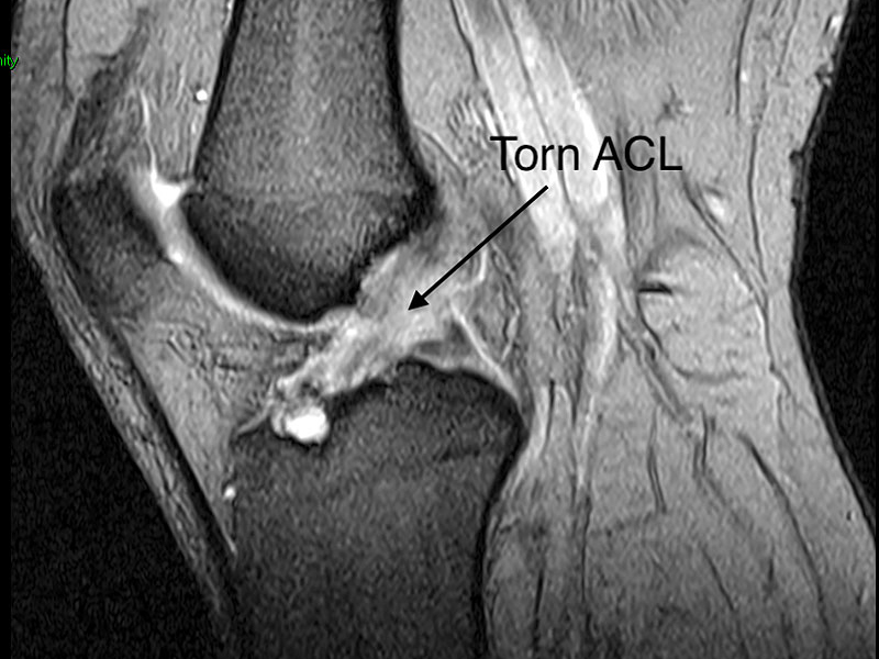 Knee Sports Injury Anterior Cruciate Ligament Acl